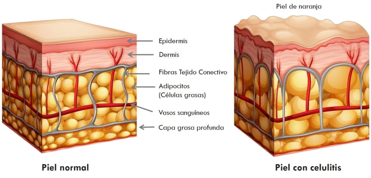 Tejidos con celulitis