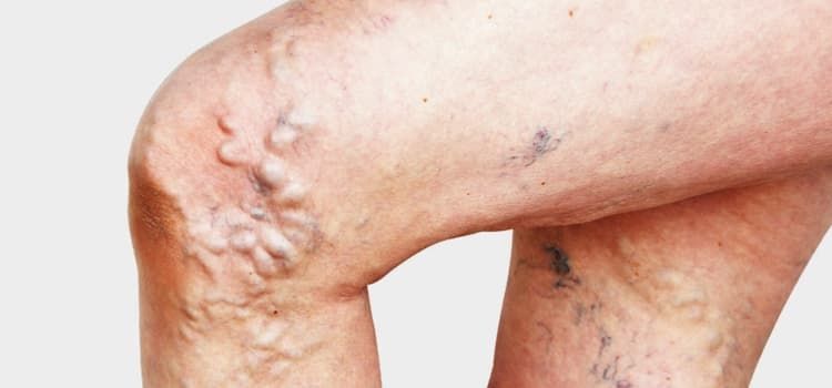 Varices miembros inferiores