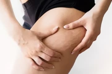 Celulitis