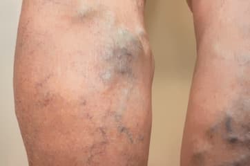 Trombosis venosas en miembros inferiores