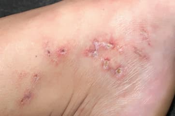 Ulceras en miembros inferiores
