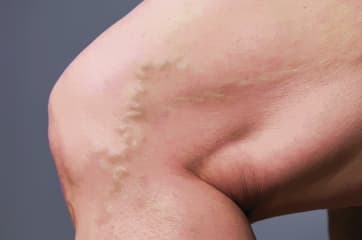 Varices en miembros inferiores