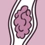 Trombosis venosas en miembros inferiores
